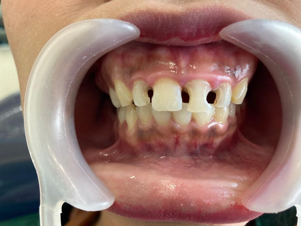 Before - Veneer ( Direct )