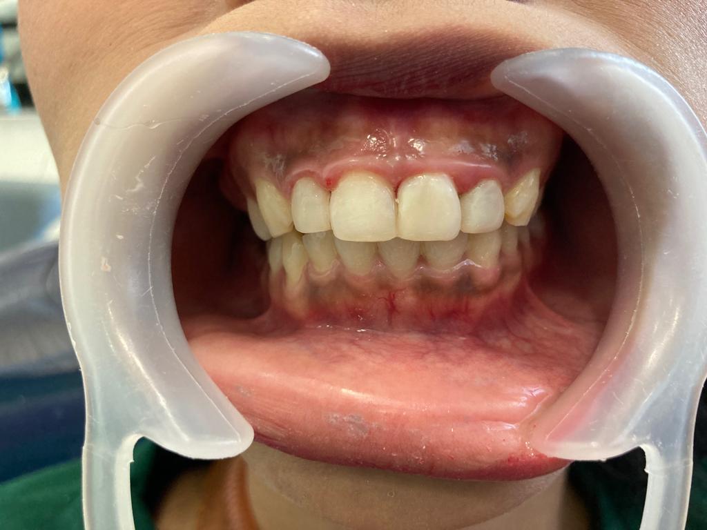 After - Veneer ( Direct )