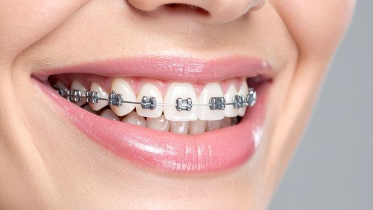 Bracket Konvensional Metal USA